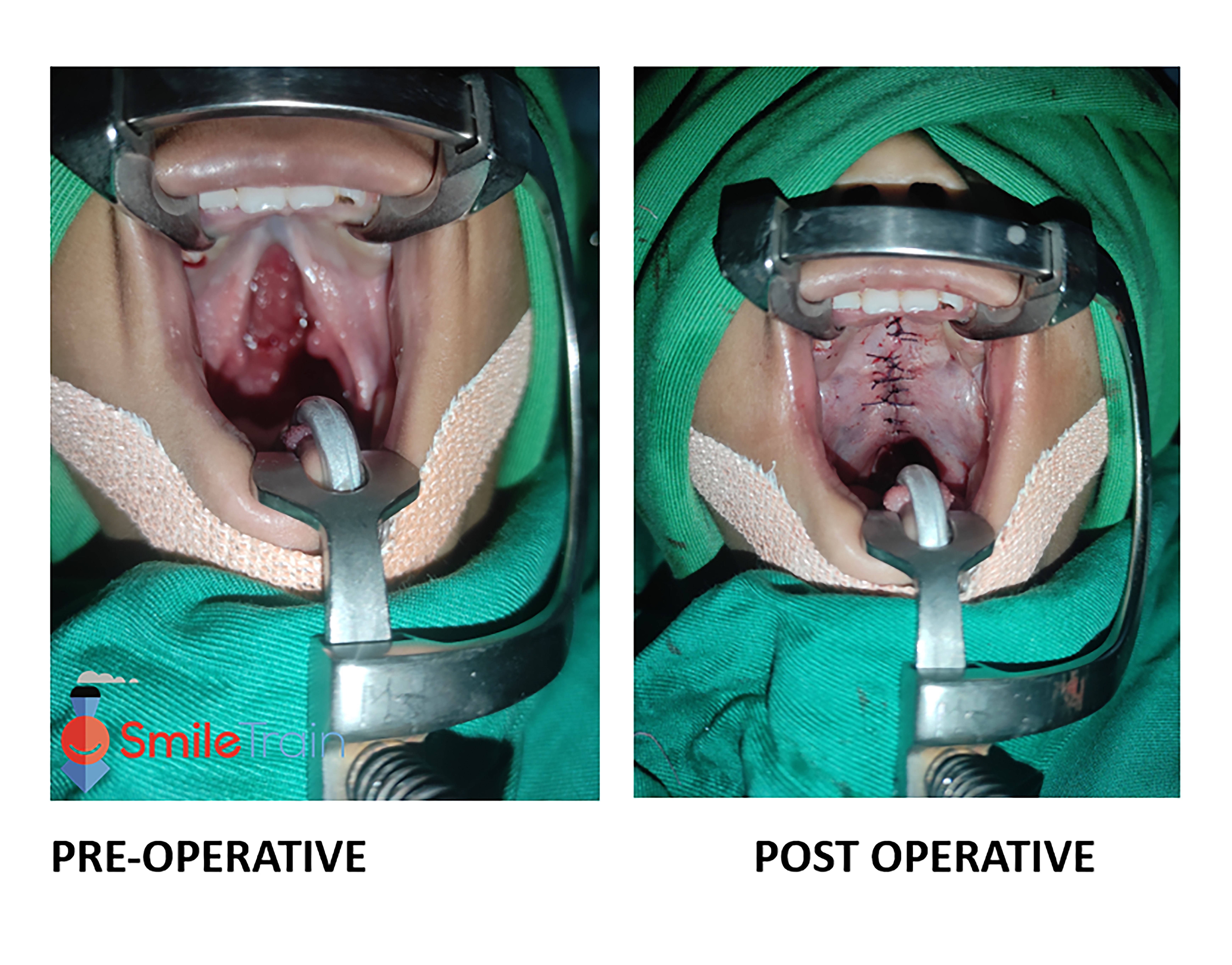 Cleft Palate
